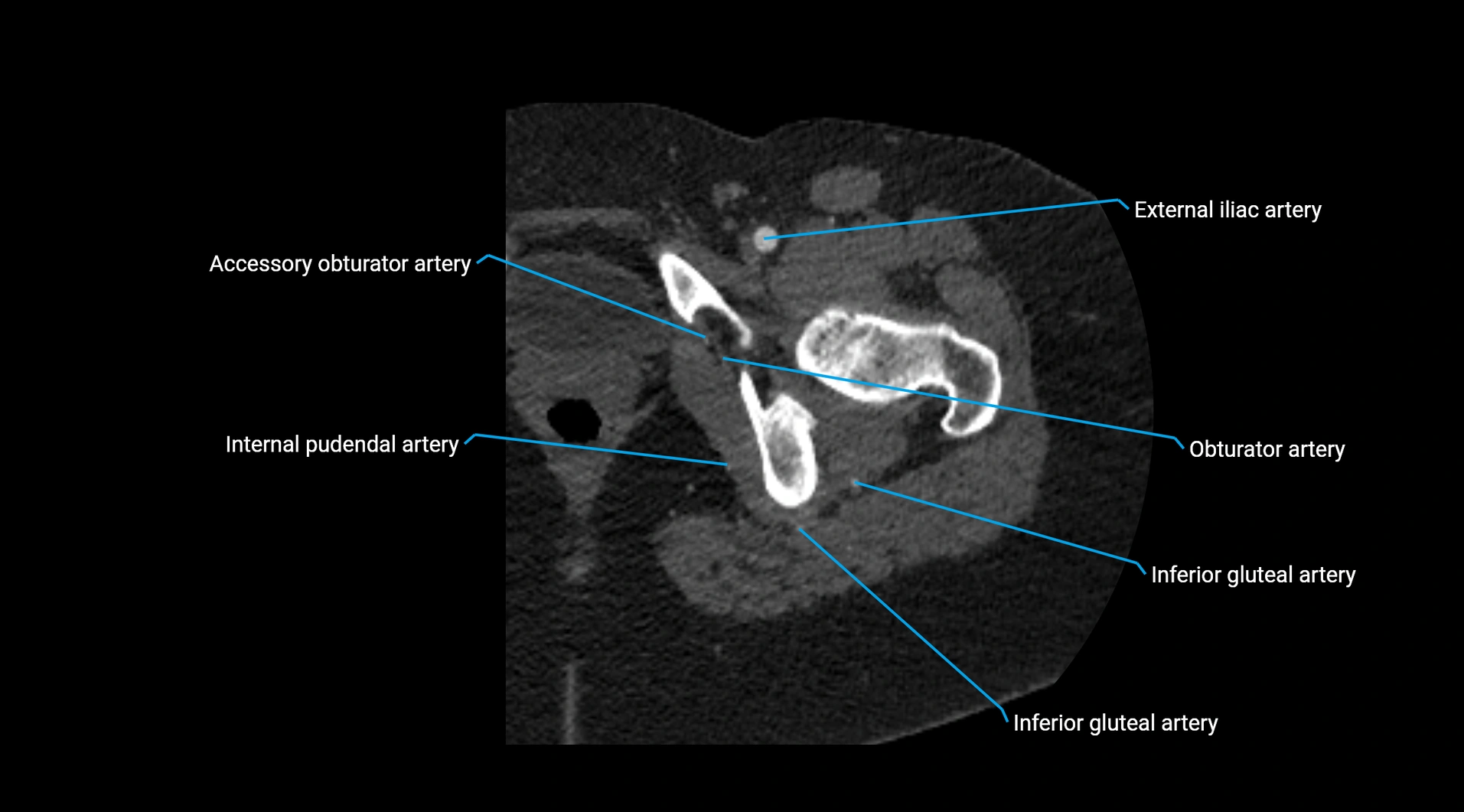 CTA lower limb cross sectional anatomy labelled image _61.webp